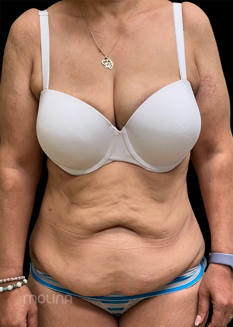 Tummy Tuck Before & After Image