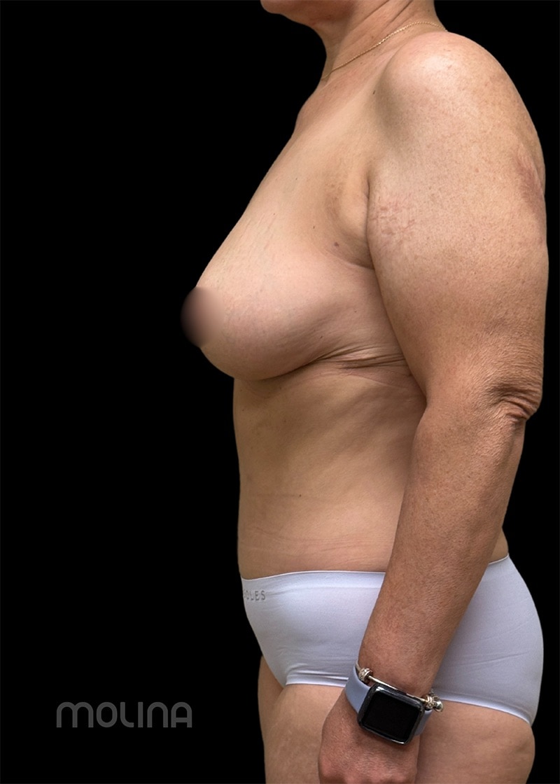 Tummy Tuck Before & After Image