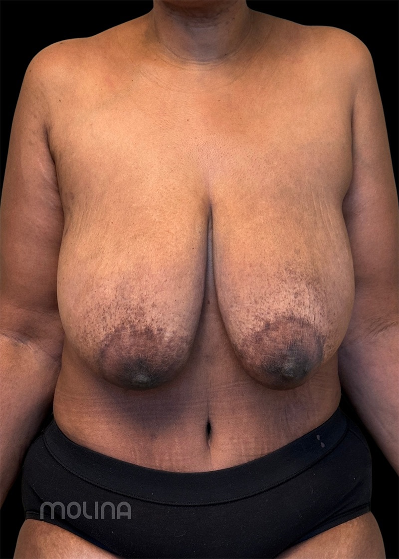 Breast Reduction Before & After Image