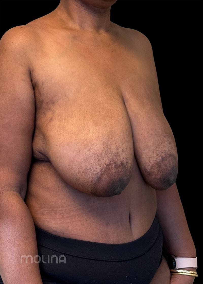 Breast Reduction Before & After Image