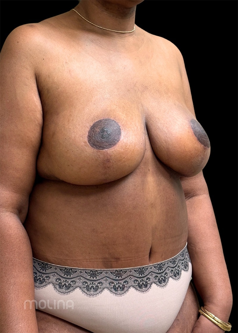 Breast Reduction Before & After Image