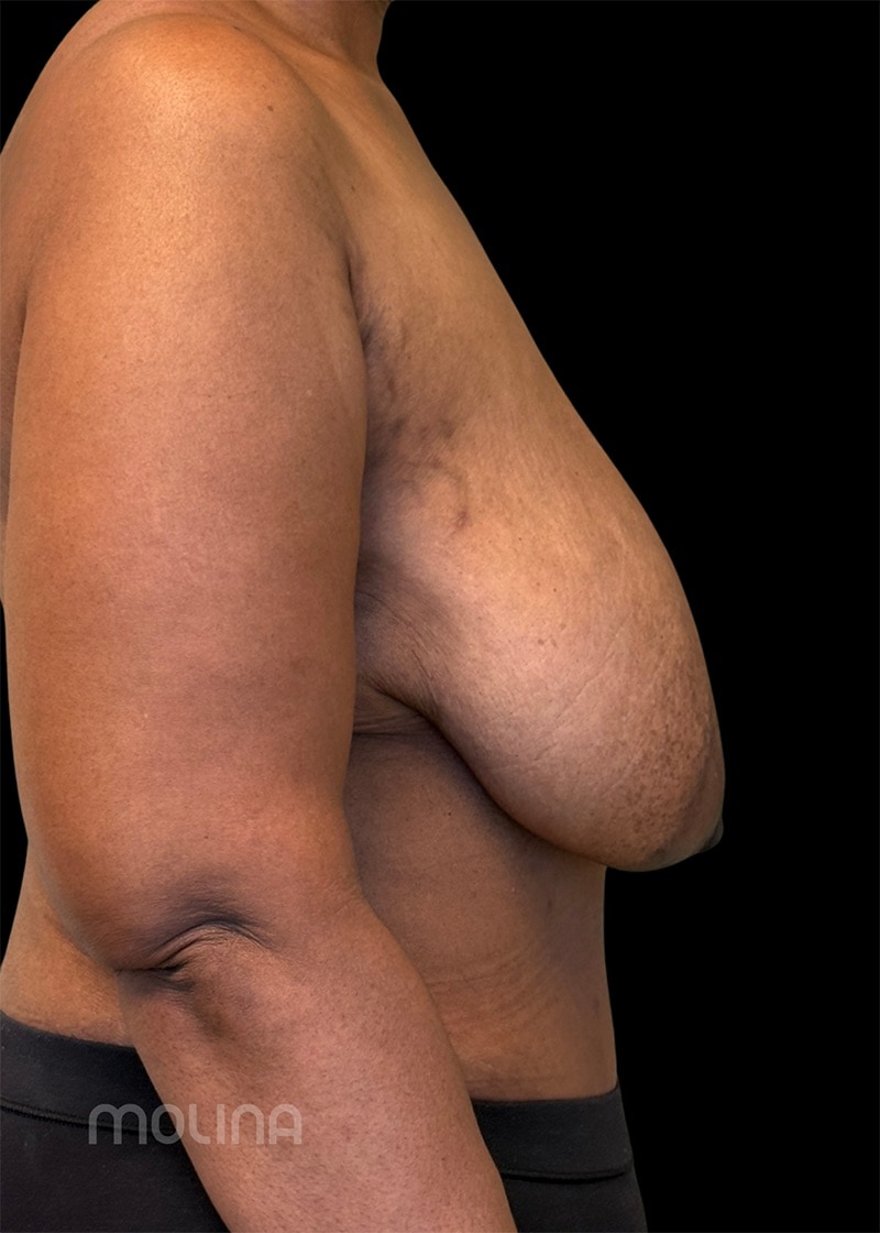 Breast Reduction Before & After Image