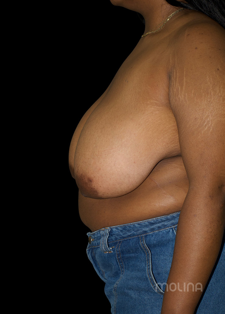 Breast Reduction Before & After Image
