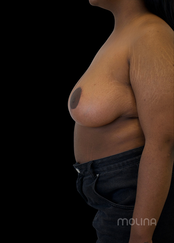 Breast Reduction Before & After Image