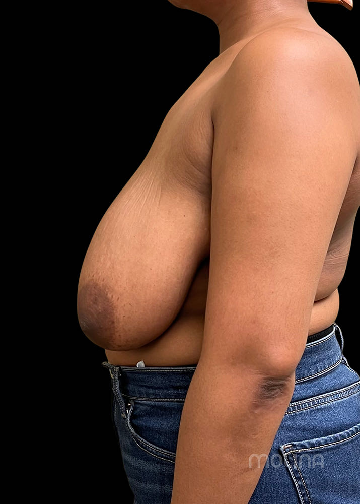 Breast Reduction Before & After Image