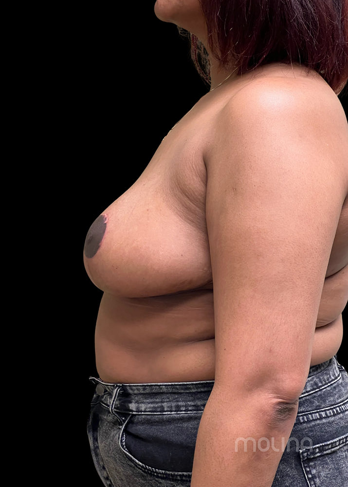 Breast Reduction Before & After Image