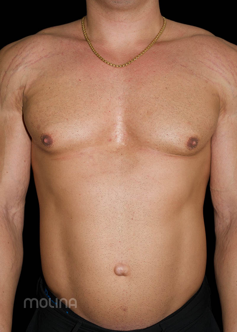 Gynecomastia Before & After Image
