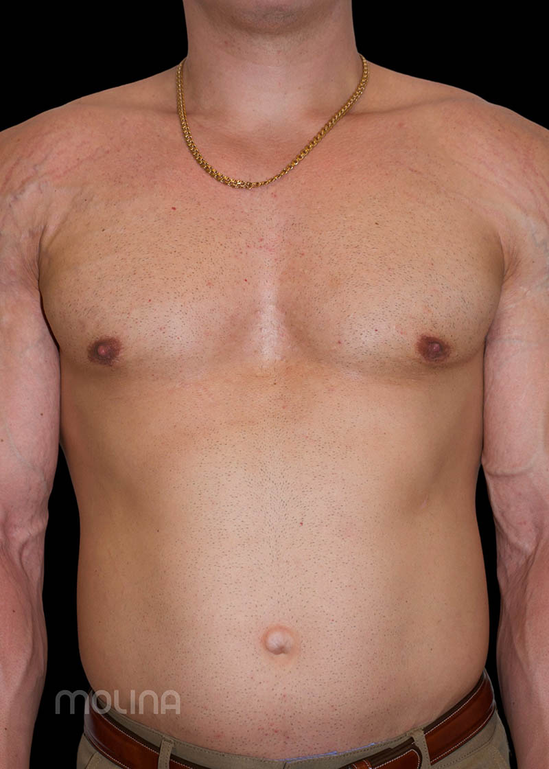 Gynecomastia Before & After Image