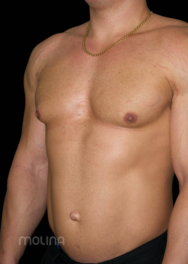 Gynecomastia Before & After Image