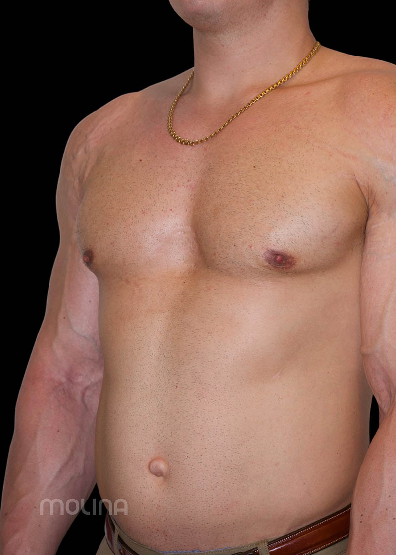 Gynecomastia Before & After Image