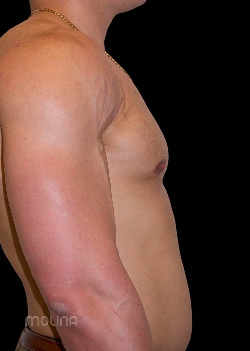 Gynecomastia Before & After Image